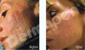 Dermapen Before and After for scar treatment (a course of 4-6 treatments is recommended)