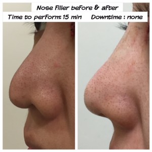 Asian Nose Filler Augmentation