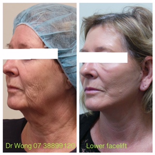 Lower facelift before & after