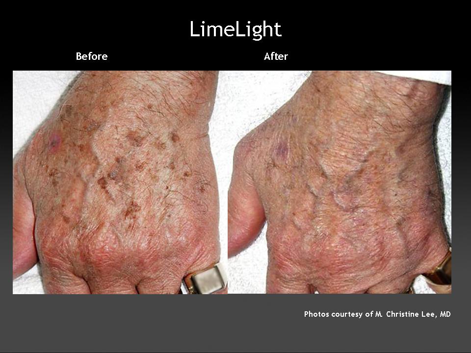 Pigmentation in hands before and after intense pulse light therapy in Brisbane