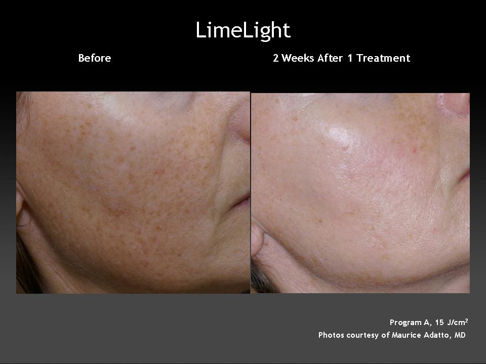 Treatment of pigmentation before and after