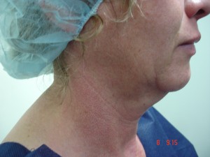 Lower Face and neck lift before and after