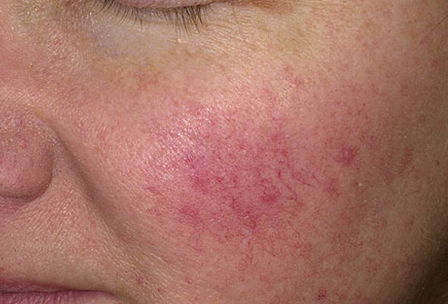 rosacea facial redness laser