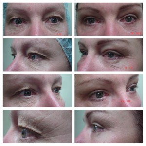Pre and Post upper and lower eyelid surgery