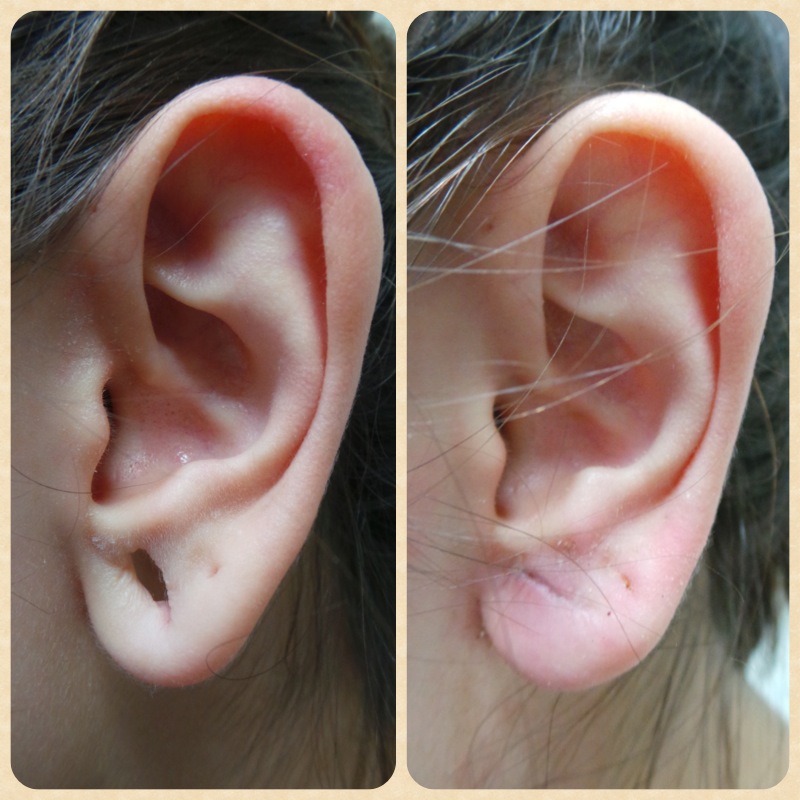 10 days after earlobe repair