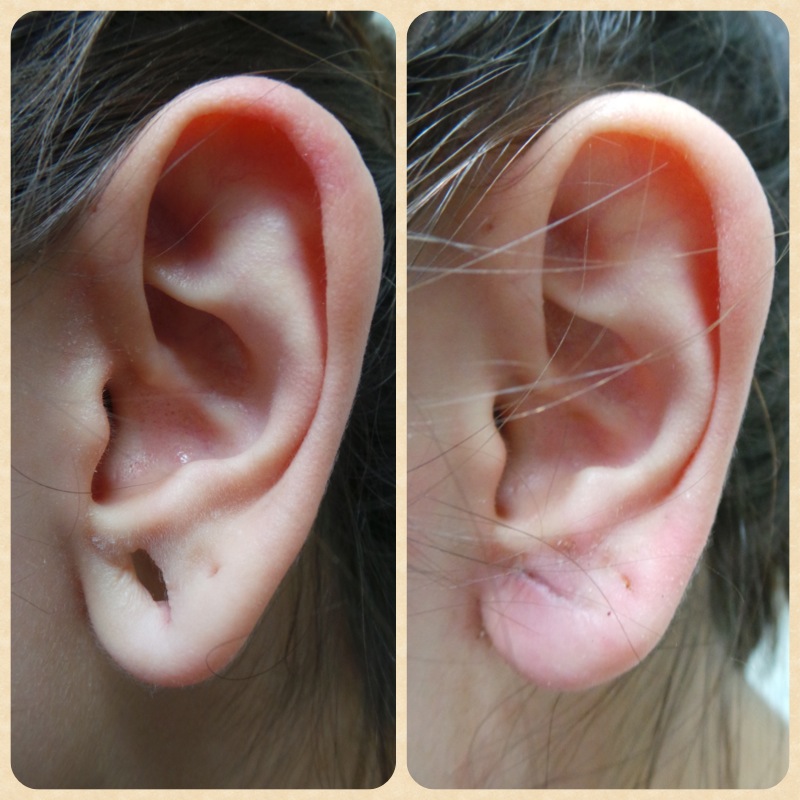 What Is Earlobe Repair Surgery In Cheshire 