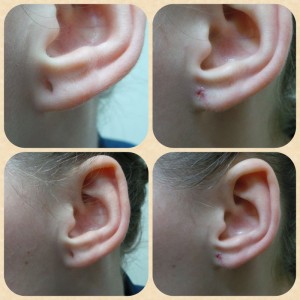 Ear lobe repair