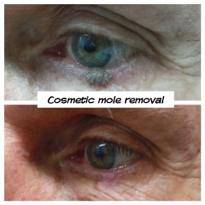 Cosmetic Mole Removal by electrosurgical ablation lower eyelid skin