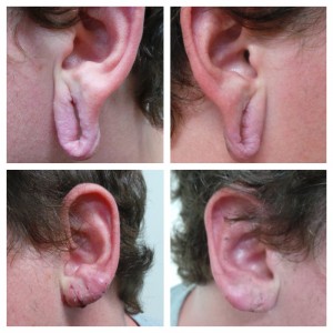 Ear Lobe Repair before & after