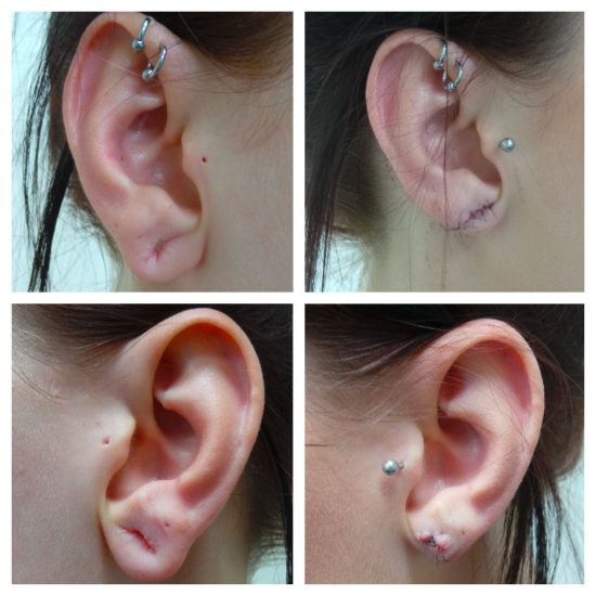 earlobe repair