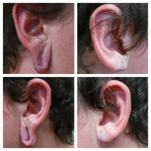 earlobe repair brisbane