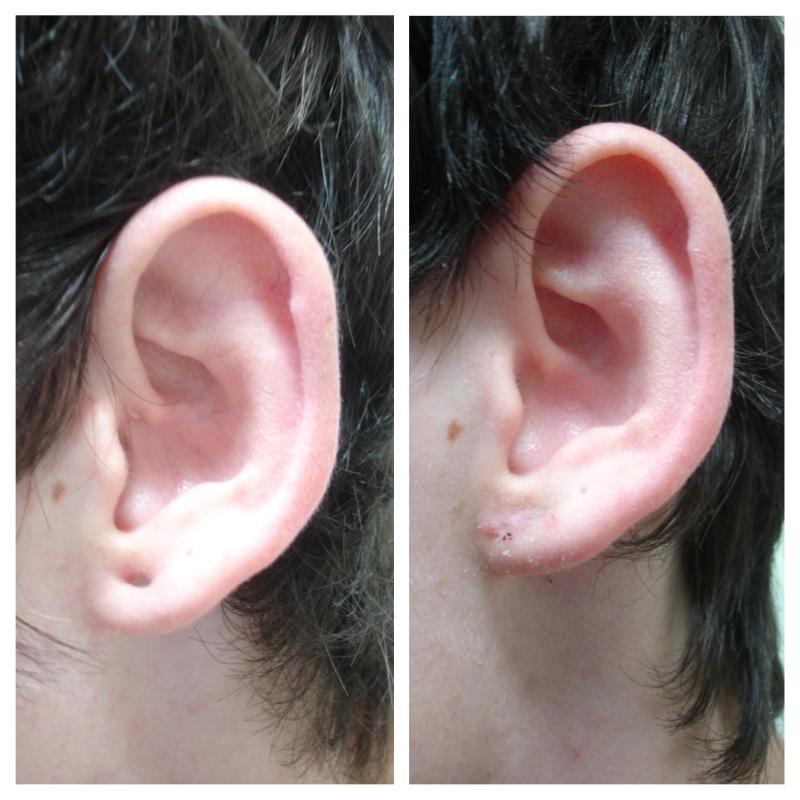 earlobe repair2