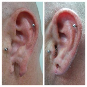 EarLobe Repair