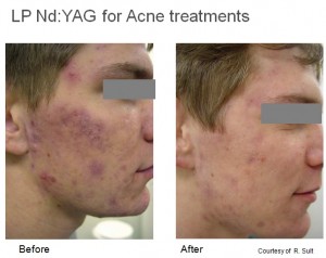 Acne laser