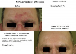 Rosacea before & after