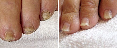 Laser Fungal Nail Infection