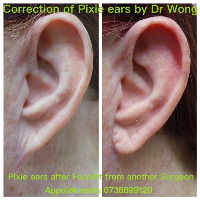 pixie ear correction