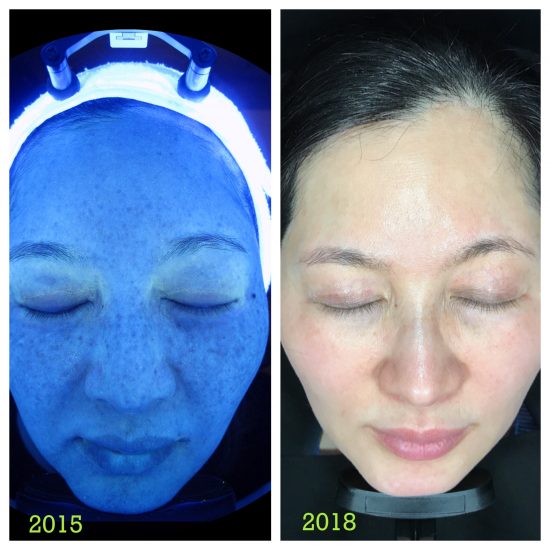 Asian Skin Whitening Laser