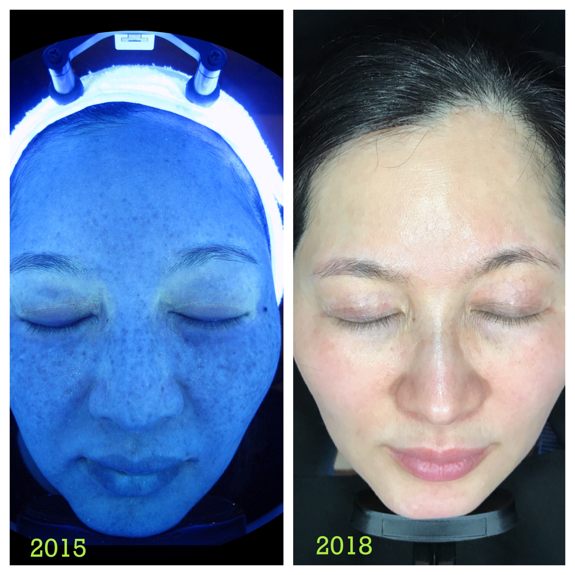 Skin Whitening Laser before and after
