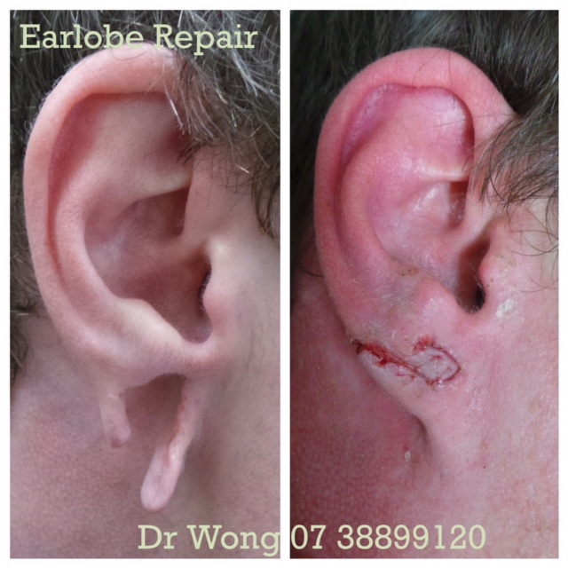 Torn earlobe repair before & after