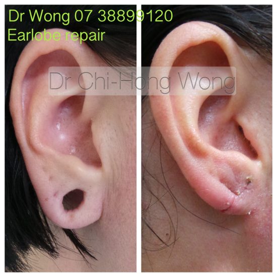 earlobe Dr Chi Hong Wong
