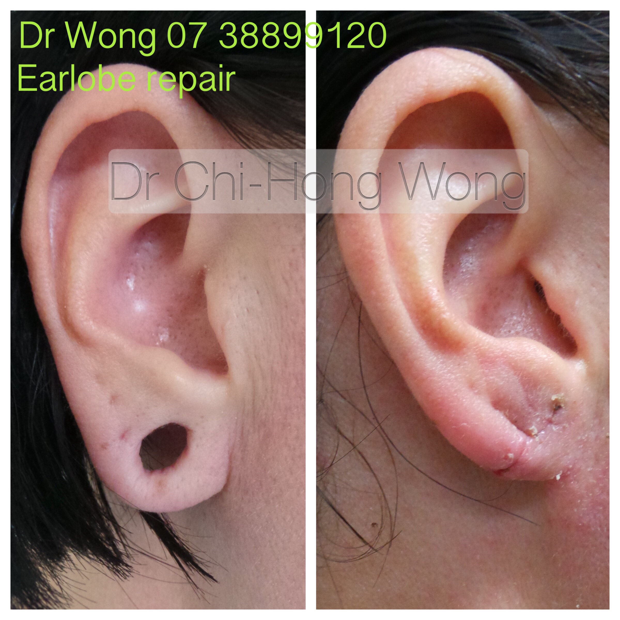 10 days after Ear lobe repair