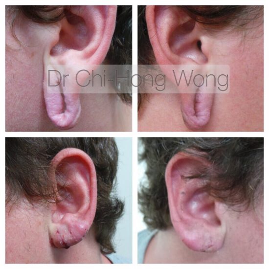 earlobe repairs Dr Wong