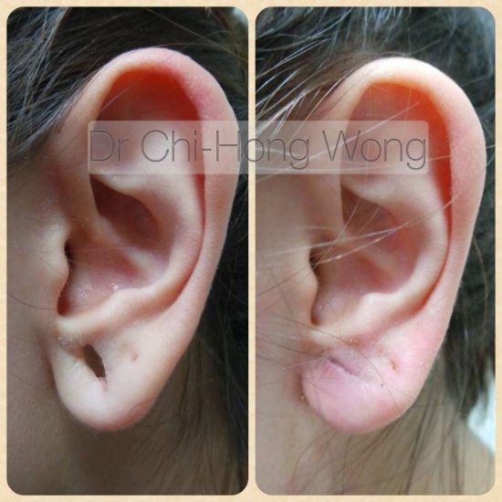 earlobe Dr C Wong
