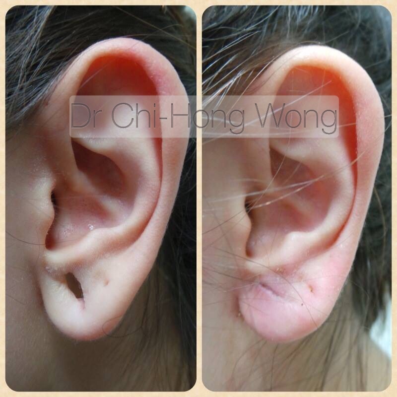earlobe repair1