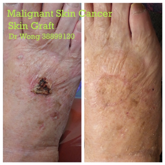 Skin Graft Foot Dorsum