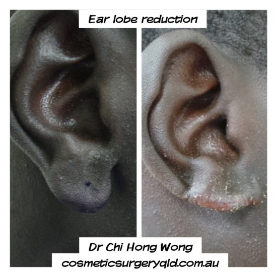 earlobe reduction