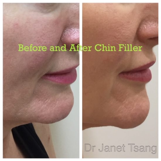 Non Surgical Chin Augmentation using Fillers